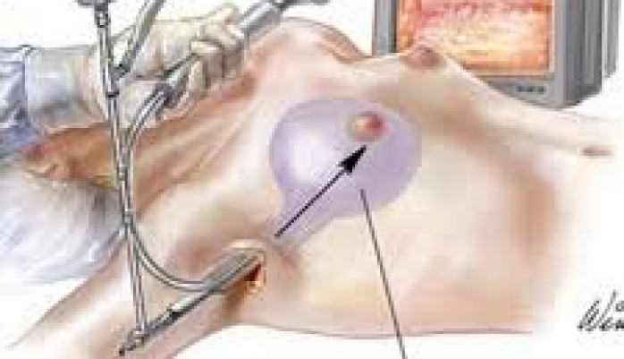 Implante mamário de silicone -via axilar.